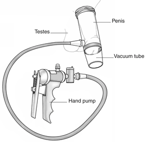 Drawing of vacuum device used to make the penis erect